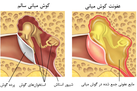 چرک کردن گوش